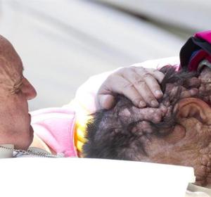 El papa Francisco abraza con ternura a un hombre de rostro completamente desfigurado