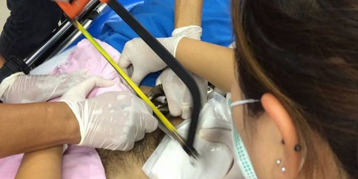 Intentaron cortar el anillo con una sierra