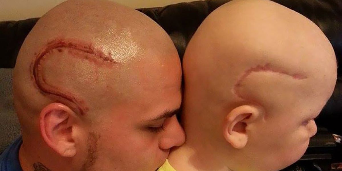 Un padre se tatúa la cicatriz de su hijo para que se sienta normal