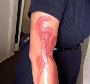 Las quemaduras que ha sufrido en el brazo Las quemaduras que ha sufrido en el brazo