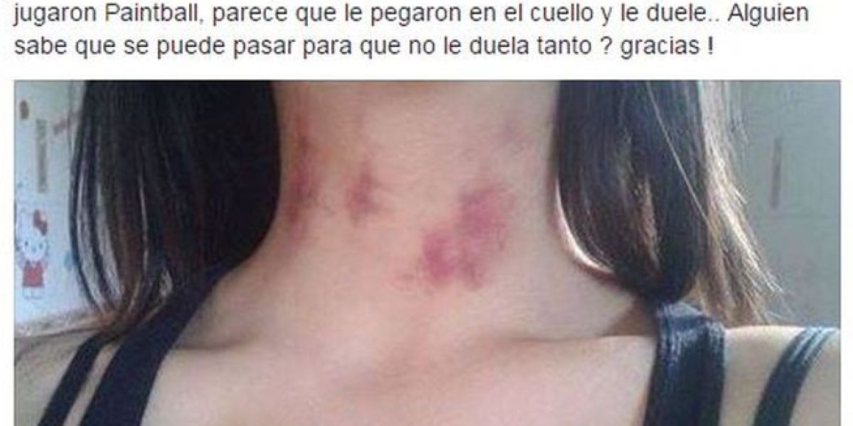 Un chico pide ayuda por los moratones de su novia y la red le explica que son chupetones
