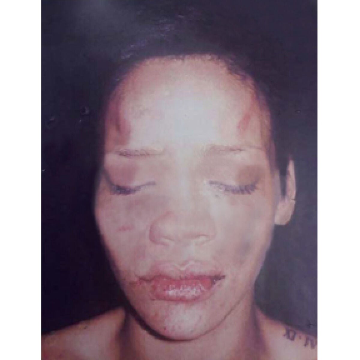 Rihanna Se Golpea Con Moretones