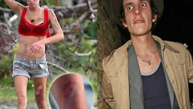 Las quemaduras de Amy y su ex