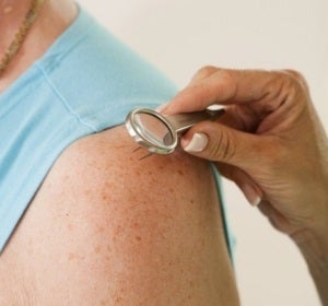 El número de lunares del brazo puede alertar de cáncer de piel El número de lunares del brazo puede alertar de cáncer de piel