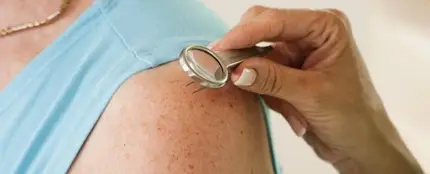 El número de lunares del brazo puede alertar de cáncer de piel El número de lunares del brazo puede alertar de cáncer de piel