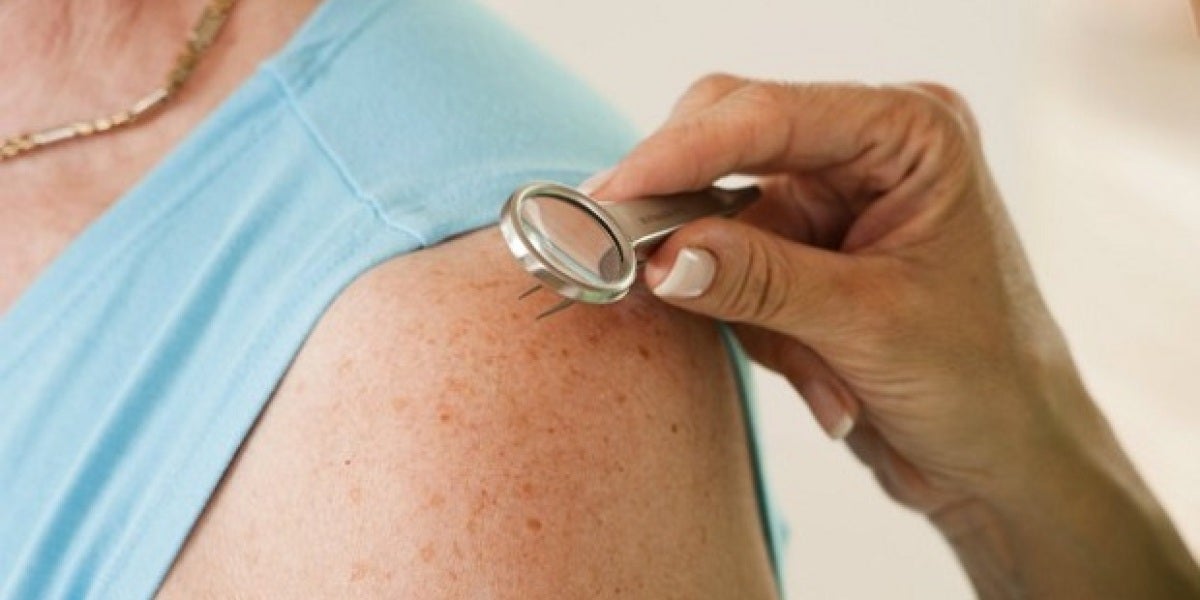 El número de lunares del brazo puede alertar de cáncer de piel