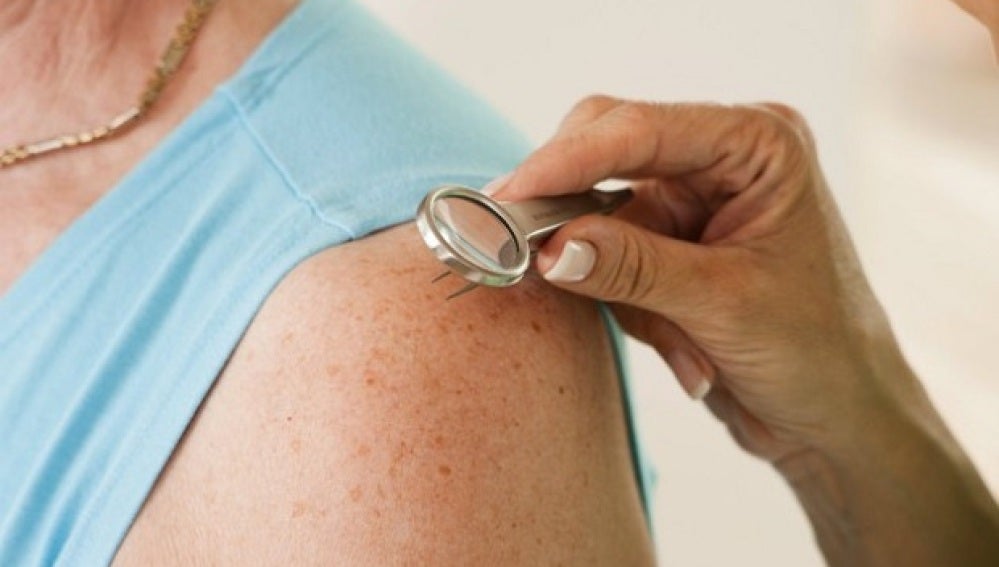 El número de lunares del brazo puede alertar de cáncer de piel