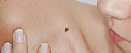 Si alguien te importa, revisa sus lunares Si alguien te importa, revisa sus lunares