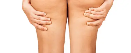 Celulitis en las piernas Celulitis en las piernas