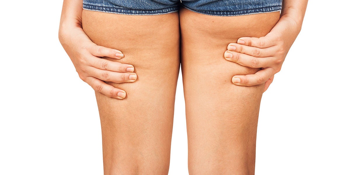 Celulitis en las piernas