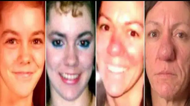 Rinofima, la enfermedad que sufre Pamela Ichard