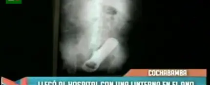 Descubren una linterna en el ano Descubren una linterna en el ano