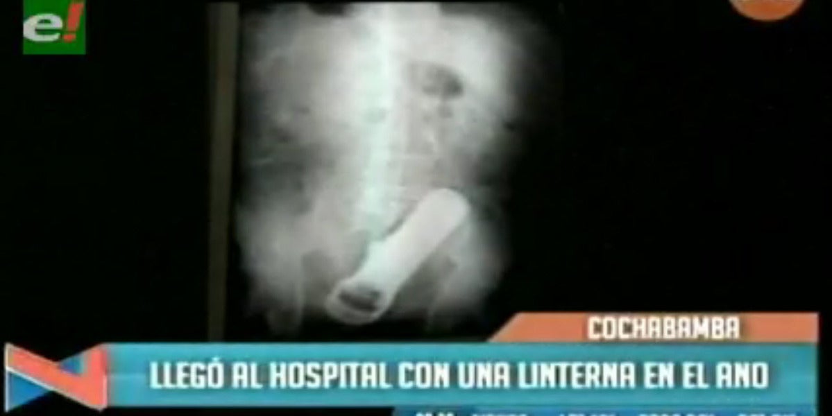 Descubren una linterna en el ano