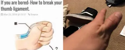 La peligrosa moda de romperse el pulgar que triunfa en las redes La peligrosa moda de romperse el pulgar que triunfa en las redes
