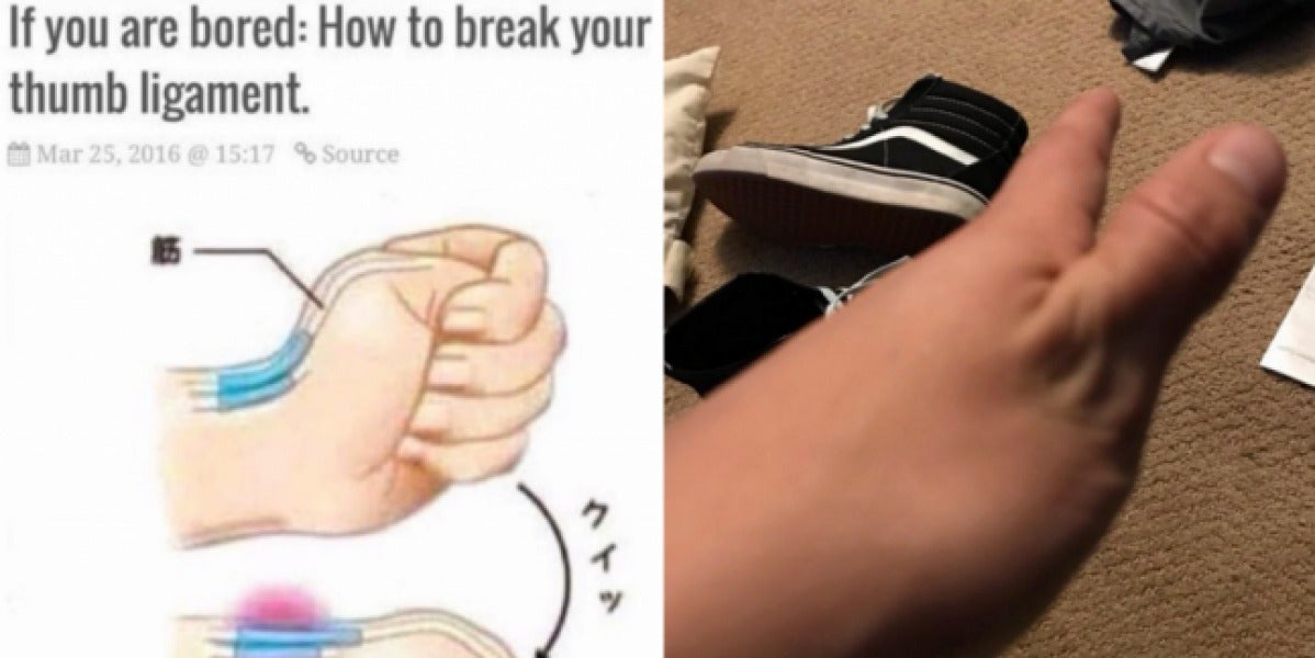 La peligrosa moda de romperse el pulgar que triunfa en las redes