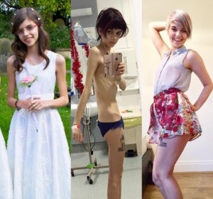 Connie Inglis documenta su recuperación de la anorexia a través de Instagram Connie Inglis documenta su recuperación de la anorexia a través de Instagram