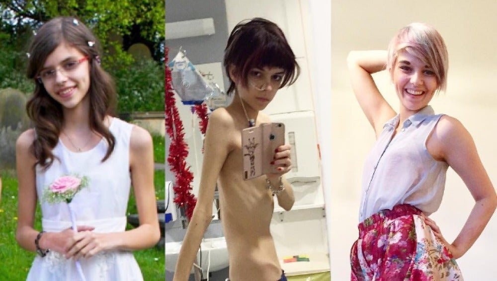 Connie Inglis documenta su recuperación de la anorexia a través de Instagram