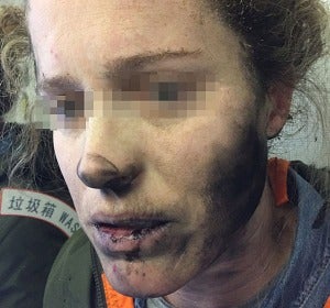Una mujer con lesiones faciales después de que los auriculares que llevaba explotaran Una mujer con lesiones faciales después de que los auriculares que llevaba explotaran