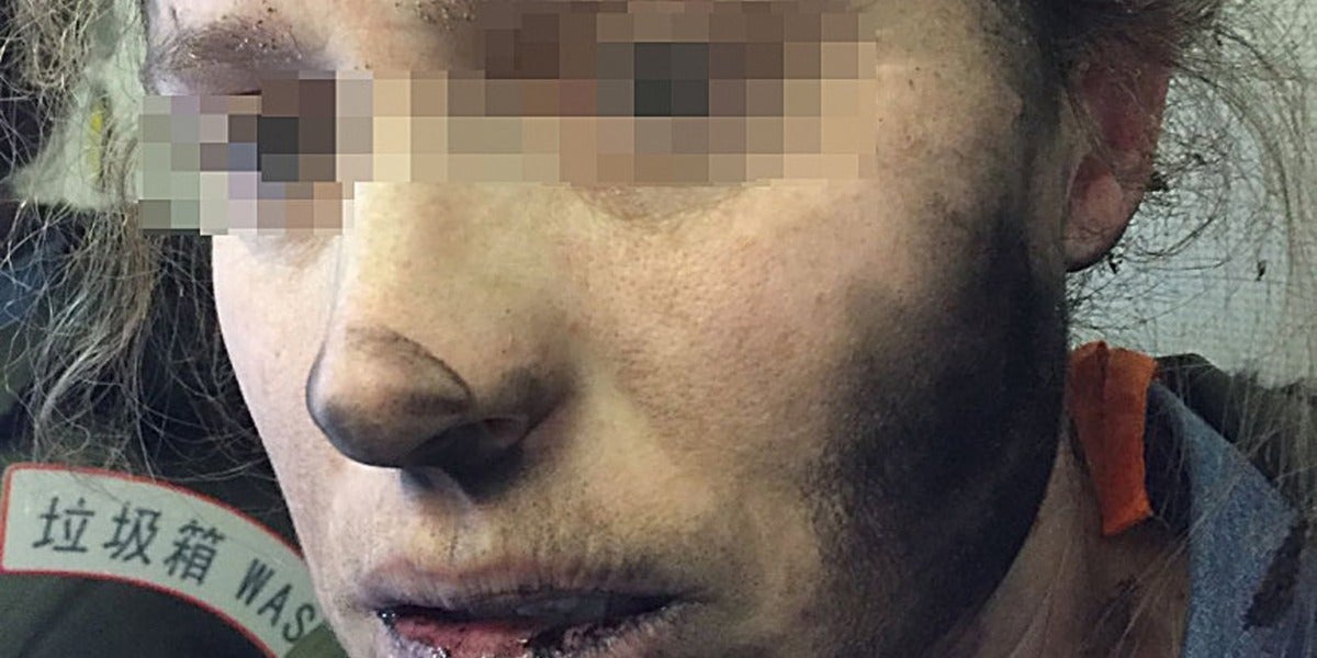 Una mujer con lesiones faciales después de que los auriculares que llevaba explotaran