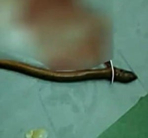 Extirpan una anguila del intestino de un hombre Extirpan una anguila del intestino de un hombre