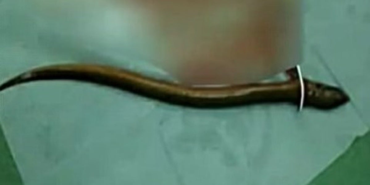 Extirpan una anguila del intestino de un hombre