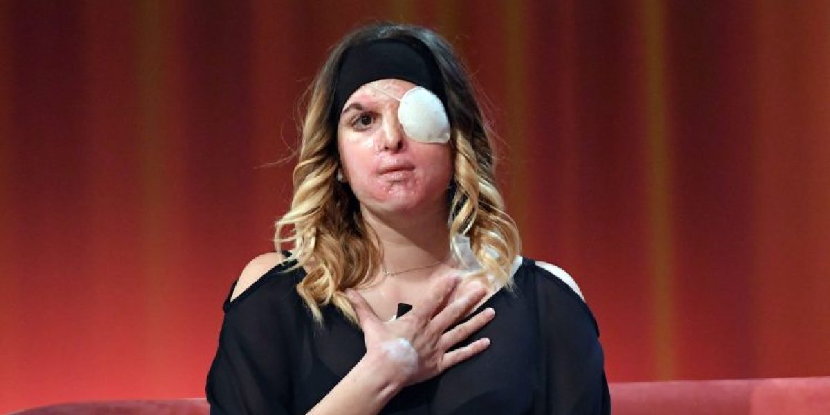 Gessica Notaro, finalista de Miss Italia agredida con ácido por su exnovio