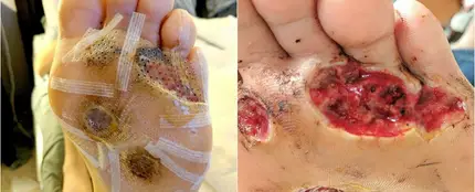 La piel de los pies pronto dividida en cinco verrugas La piel de los pies pronto dividida en cinco verrugas