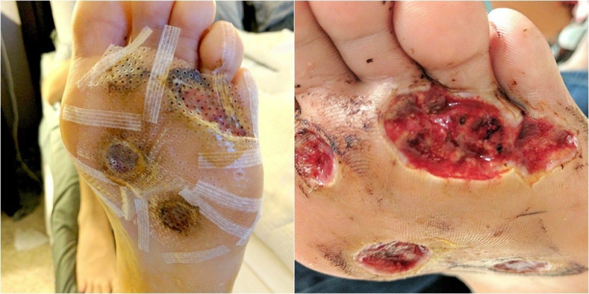 La piel de los pies pronto dividida en cinco verrugas