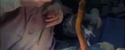 Una anguila siendo extraída durante la intervención quirúrgica