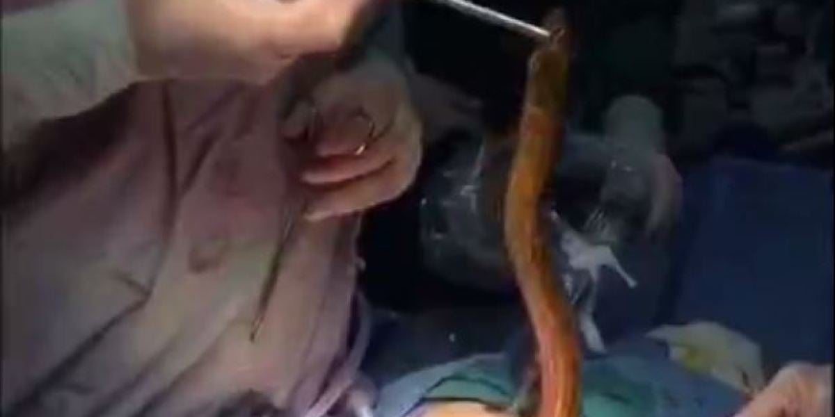 Una anguila siendo extraída durante la intervención quirúrgica