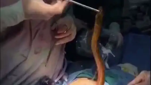 Una anguila siendo extraída durante la intervención quirúrgica