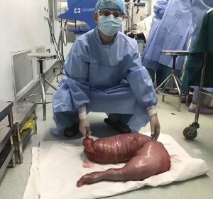 Un cirujano con el intestino de 13 kilos Un cirujano con el intestino de 13 kilos