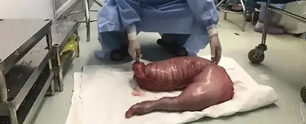 Un cirujano con el intestino de 13 kilos Un cirujano con el intestino de 13 kilos
