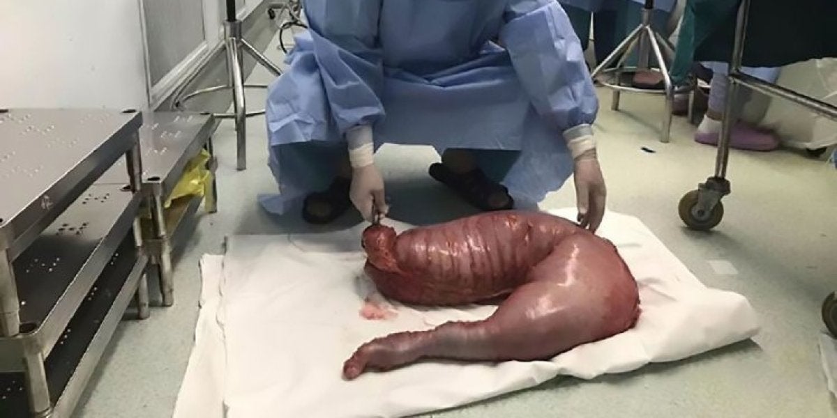 Un cirujano con el intestino de 13 kilos
