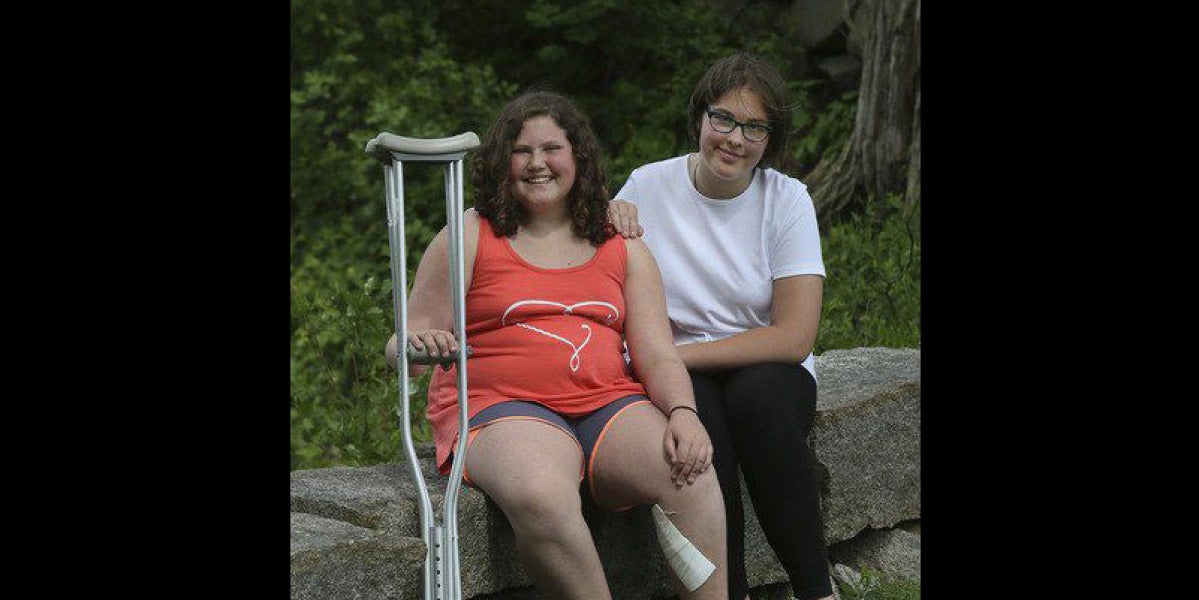 Megan Gething y su amiga tras la cirugía