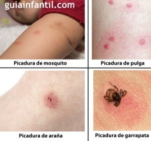 Guía para identificar picaduras de insectos Guía para identificar picaduras de insectos
