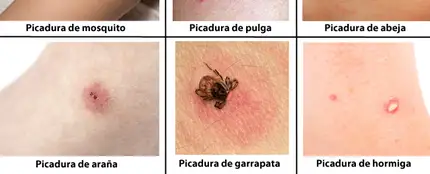 Guía para identificar picaduras de insectos Guía para identificar picaduras de insectos