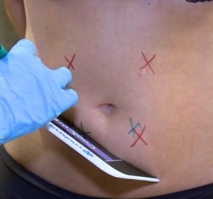 Llega una alternativa a la liposucción: congelar la grasa localizada a 11 grados bajo cero Llega una alternativa a la liposucción: congelar la grasa localizada a 11 grados bajo cero