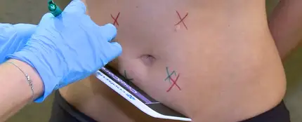Llega una alternativa a la liposucción: congelar la grasa localizada a 11 grados bajo cero Llega una alternativa a la liposucción: congelar la grasa localizada a 11 grados bajo cero