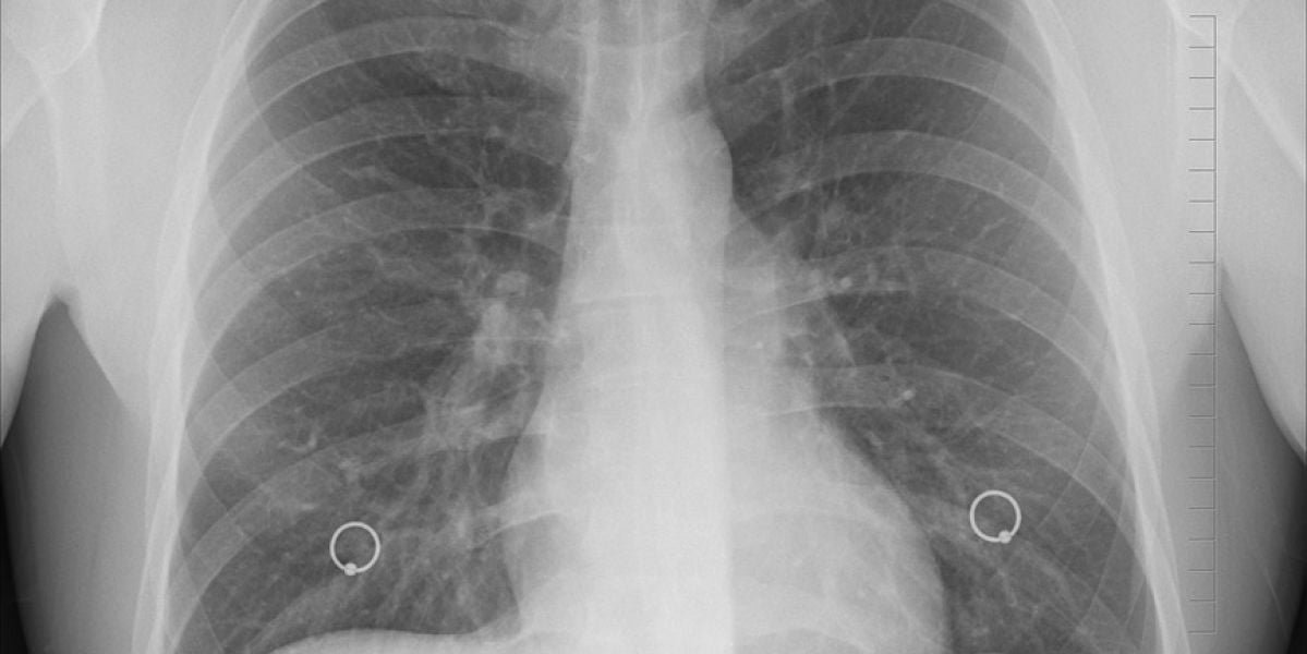 Científicos descubren una nueva solución que frena la metástasis en el pulmón