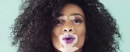 La modelo con vitiligo Winnie Harlow La modelo con vitiligo Winnie Harlow