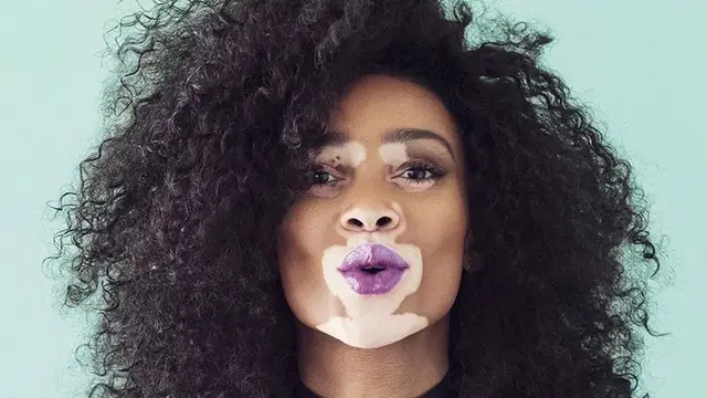 La modelo con vitiligo Winnie Harlow