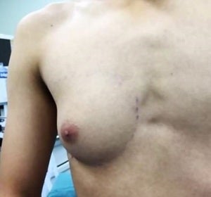 Torso del adolescente afectado por la ginecomastia Torso del adolescente afectado por la ginecomastia