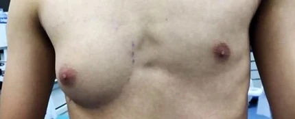 Torso del adolescente afectado por la ginecomastia Torso del adolescente afectado por la ginecomastia