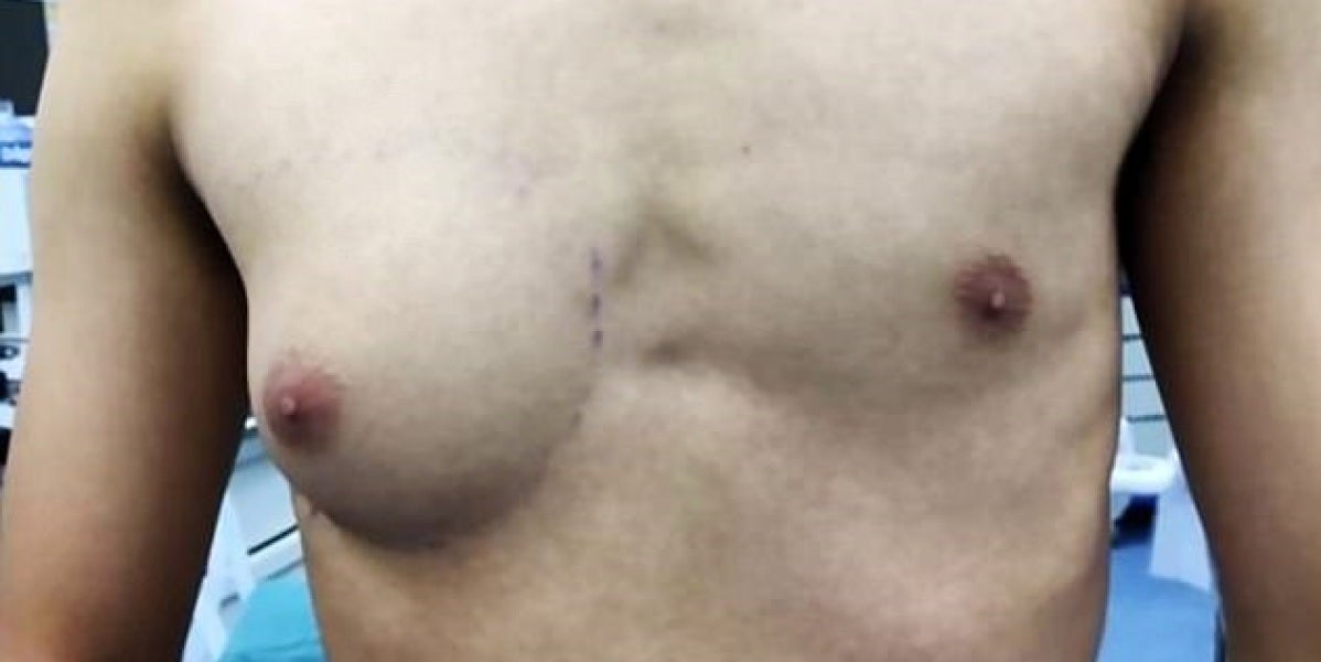 Torso del adolescente afectado por la ginecomastia