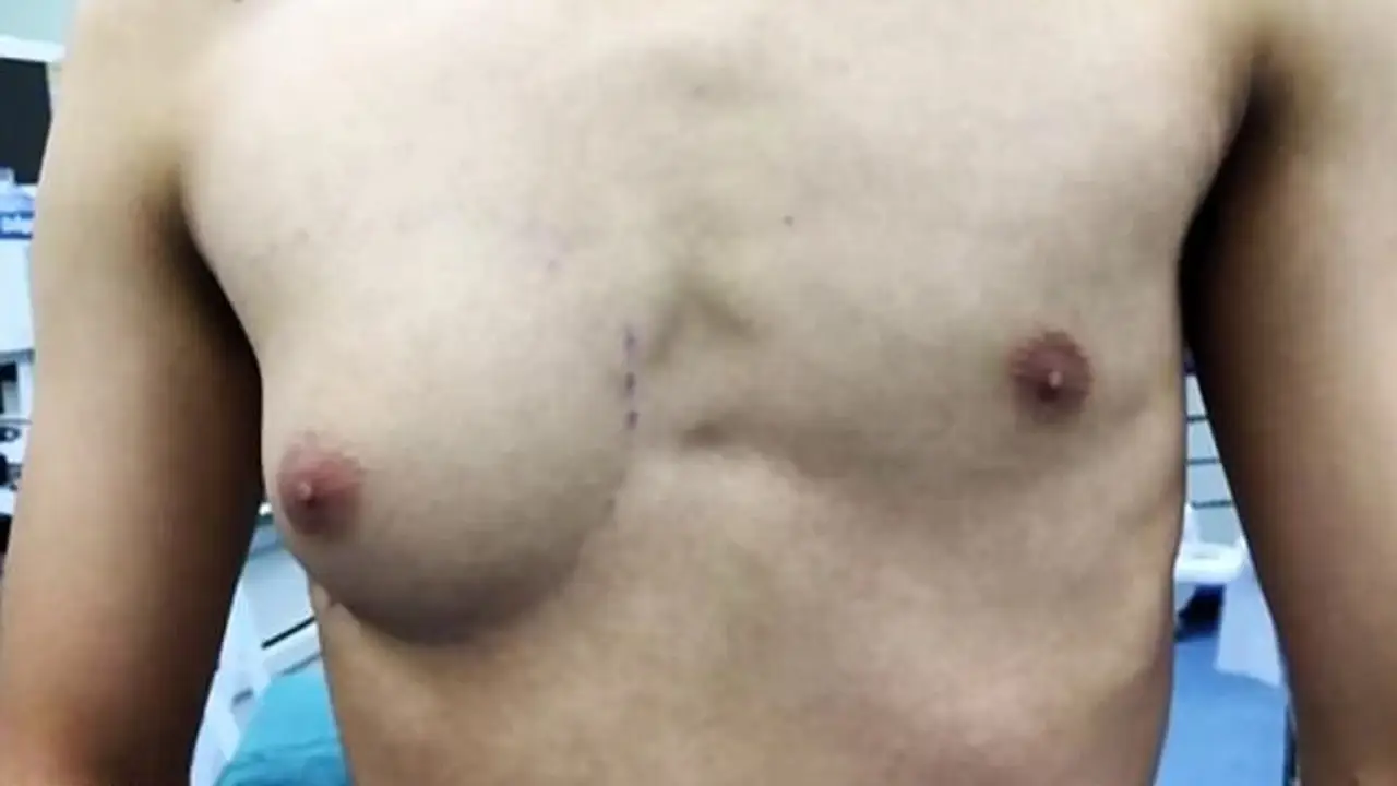 Torso del adolescente afectado por la ginecomastia Torso del adolescente afectado por la ginecomastia