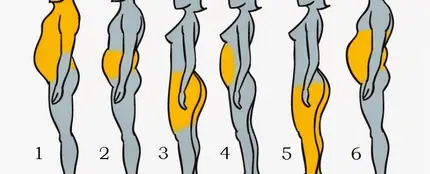 Los seis tipos de obesidad que existen Los seis tipos de obesidad que existen