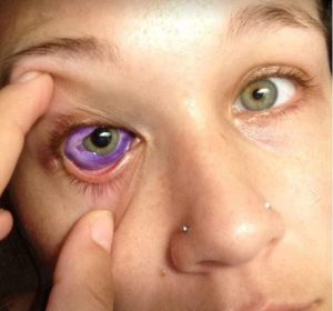 El tinte ocular se le agolpa alrededor de la córnea. El tinte ocular se le agolpa alrededor de la córnea.