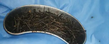 Los clavos que se había comido el paciente Los clavos que se había comido el paciente