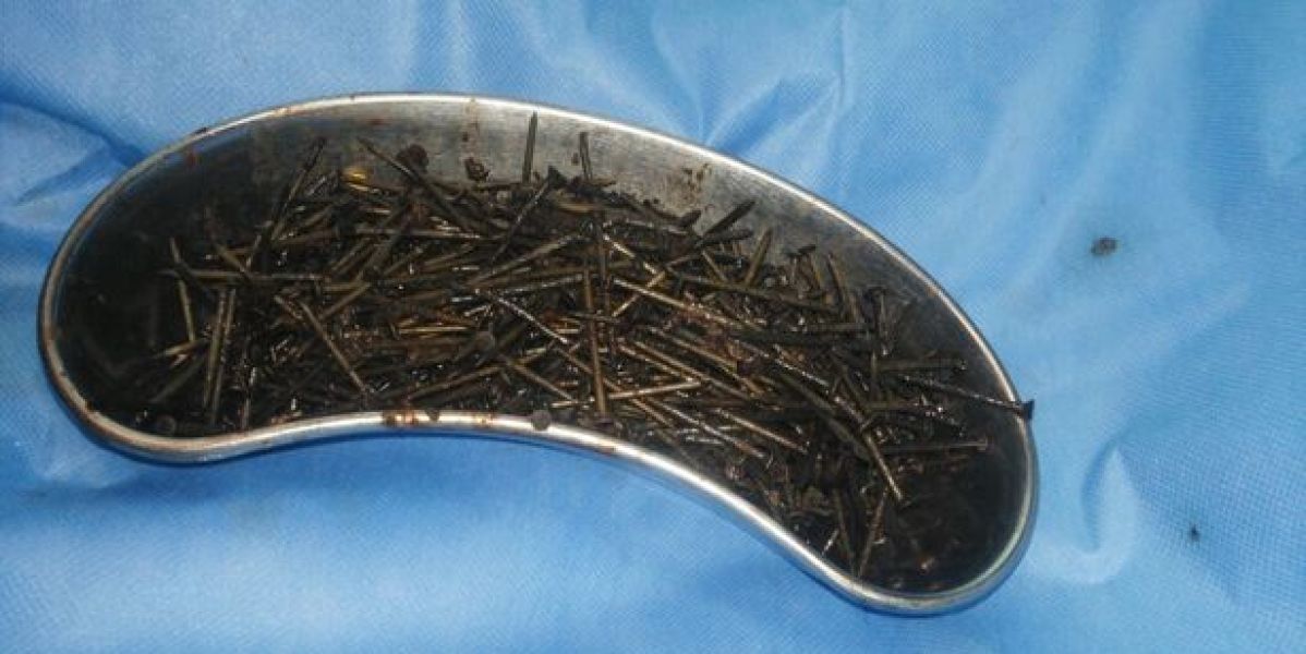 Los clavos que se había comido el paciente